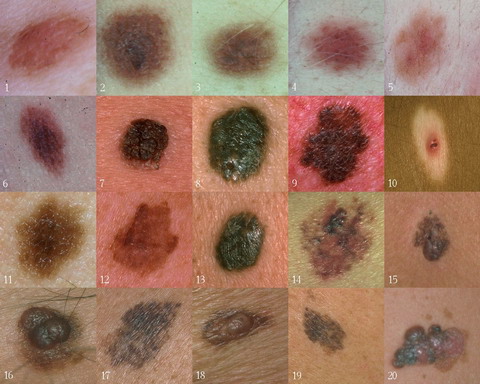 Sample of Skin Cancer Moles